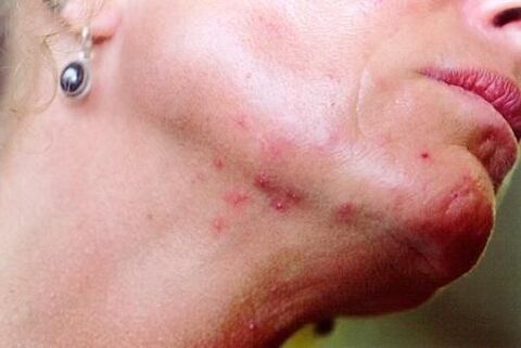 redness of the skin caused by worms