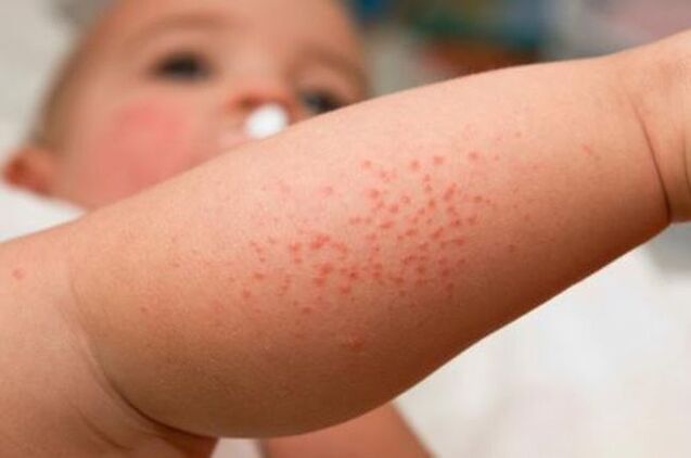 rash caused by parasites