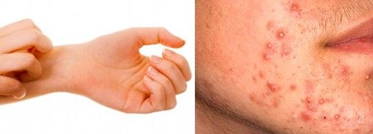 Symptoms of human subcutaneous parasites