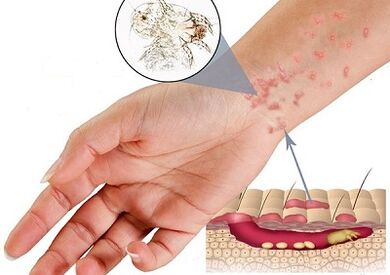 The manifestation of subcutaneous parasites in humans