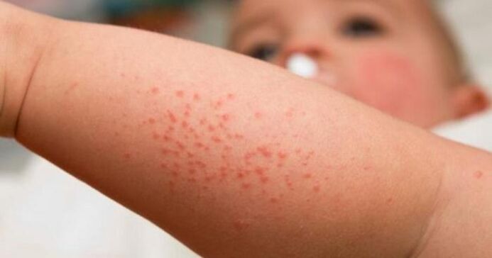 Rash is a symptom of parasitic infection