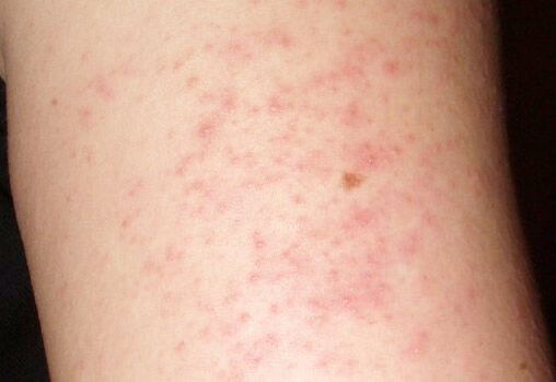 Itchy rash is a symptom of worms in the liver