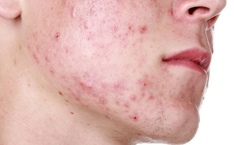 A rash on the face caused by a parasite