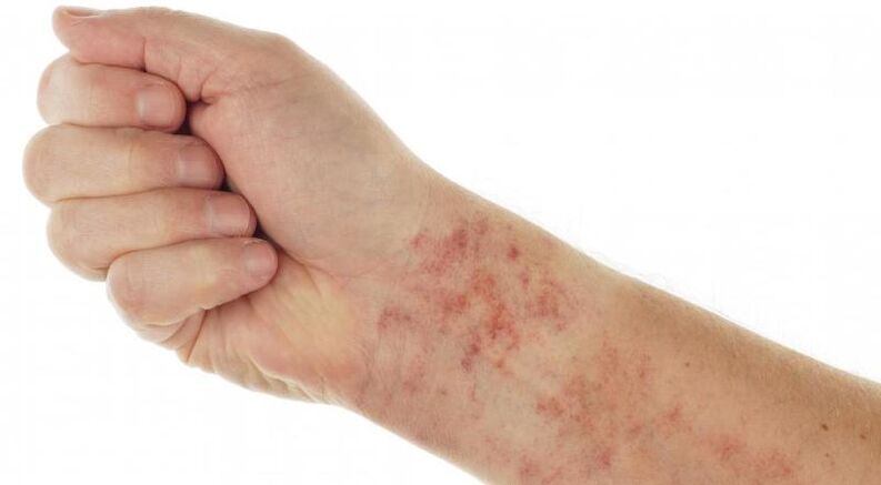 Skin rash when parasites are present in the body